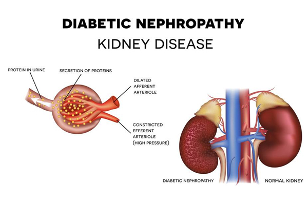 New Clue to Diabetic Nephropathy