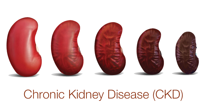 Stages of chronic kidney disease